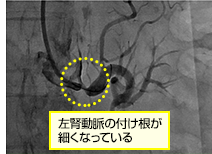 腎動脈形成術治療 治療前