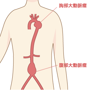 胸部大動脈瘤・腹部大動脈瘤