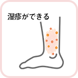 湿疹ができる