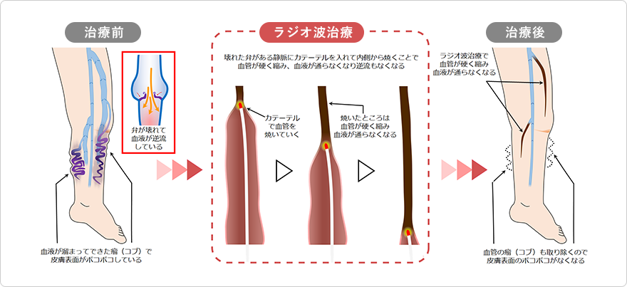 当院の下肢静脈瘤の「ラジオ波治療」