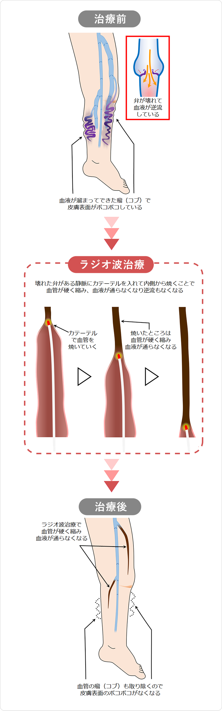 当院の下肢静脈瘤の「ラジオ波治療」